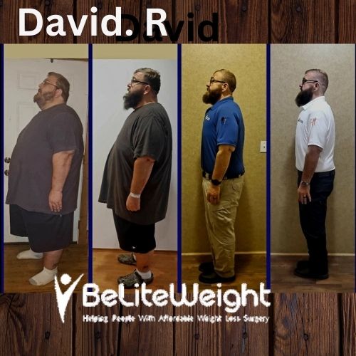 David R- 2 years after RNY gastric bypass